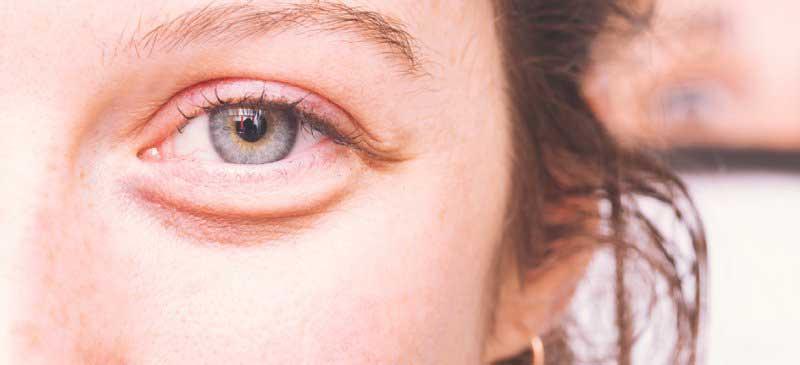 کیسه زیر چشم چیست و چگونه درمان می شود؟ کیسه زیر چشم چیست و چگونه درمان می شود؟