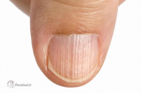 علت شیاردار شدن و خطوط روی ناخن چیست؟ دلیل شیاردار شدن و خطوط روی ناخن چیست؟